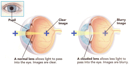Diagram of a cataract